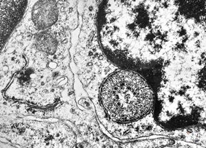 M,41y. | hairy cell leukemia - spleen - ribosome-lamella complex in tricholeukocyte